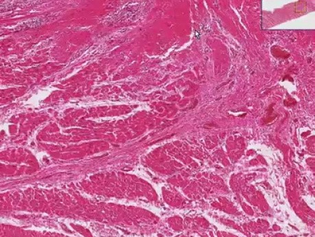 Subacute rheumatic endocarditis - Heart - Histopathology