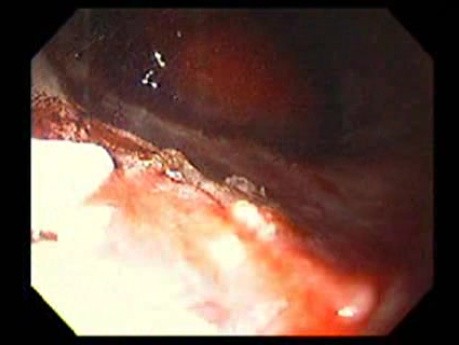 Bleeding Due to Dieulafoy´s Lesion (8 of 8)