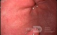 Gastric Polyp Located In The Cardia