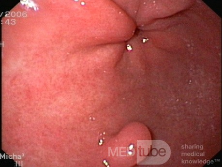 Gastric Polyp Located In The Cardia
