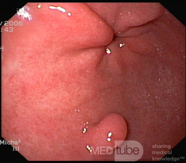 Gastric Polyp Located In The Cardia