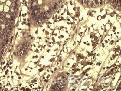 High power view of brown pigment inside of macrophages
 at the lamina propria