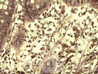 High power view of brown pigment inside of macrophages
 at the lamina propria