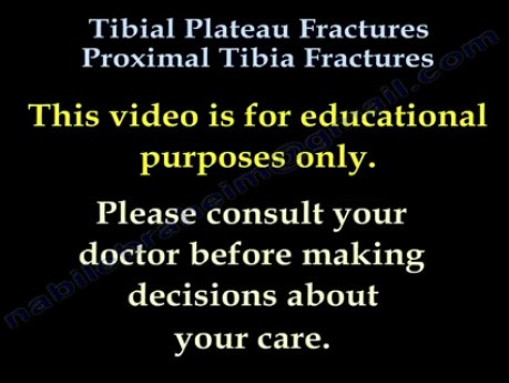 Tibial Plateau Fractures Proximal Tibia Fractures 