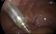 Laparoscopic Gallstone Ileus Treatment 