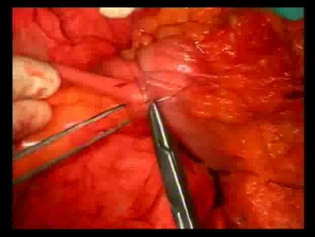 Open Right Hemicolectomy – Technical Principles - Operation No 1B - Part 6