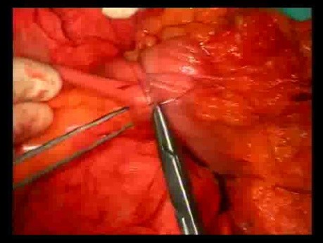 Open Right Hemicolectomy – Technical Principles - Operation No 1B - Part 6