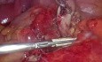 Laparoscopic Retrograde Appendectomy with Staples