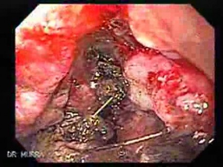Adenocarcinoma of the Cardia and Carcinoma Epidermoid of the Larynx (19 of 26)