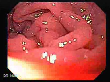 Celiac Disease - Duodenal Mucosa (3 of 5)