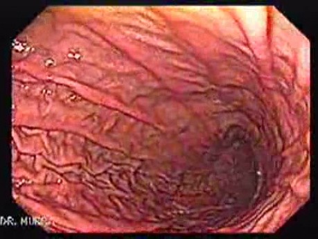 The Gastric Body - Rugal Folds (1 of 6)