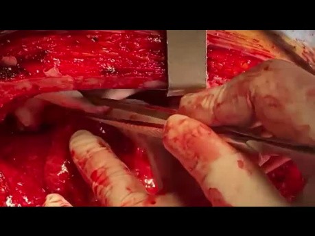 Left Lower Lobe Tumor of the Lung with Invasion to LV Lateral Aspect and Apex 