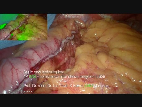 ICG Fluorescence of His Angle by Sleeve Gastric Resection