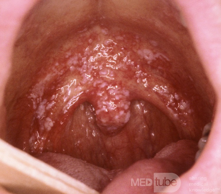 Acute Thrush