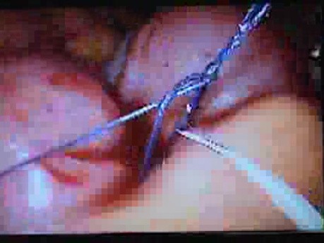 Jejunal Gastrointestinal Stromal tumor (GIST) (78 of 86)