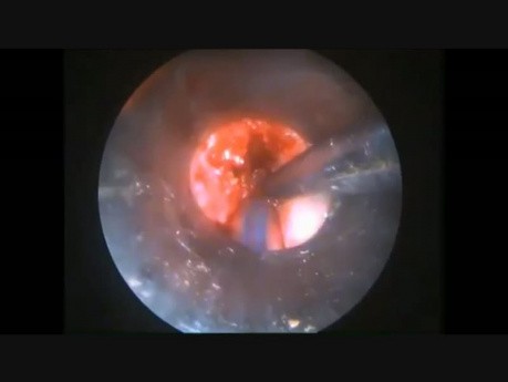 Endoscopic Transglottic Tumour Excision 2