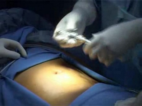 Total Extra Peritoneal (TEP) in 10 steps - Part 1