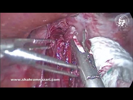 Achalasia Surgery - Mobilizing the Left Hemiliver by Dividing the Triangular Ligament to Expose the Lower Esophagus