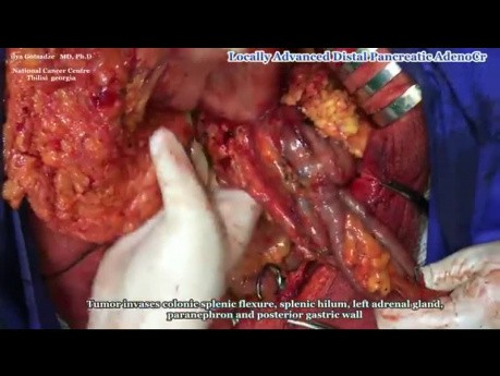 Extended Radical Antegrade Modular PancreatoSplenectomy (RAMPS)