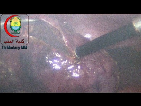 To Evacuate the GB From Stones And Suck Its Contents And Proceed To Subtotal Cholecystectomy May Be Better