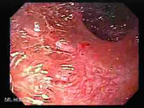 Ileal Neobladder Substitution (ileal bladder) (7 of 9)
