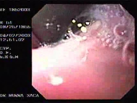 Banding of Esophageal Varices - Presence of Ulcer After Ligation