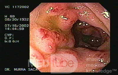 Amebic Colitis