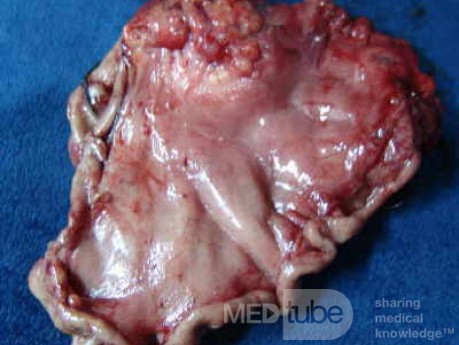 Diffuse Adenocarcinoma with signet ring cells (9 of 18)