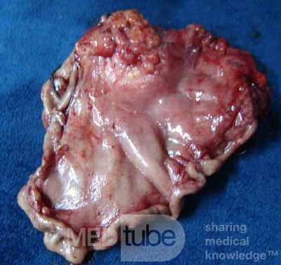Diffuse Adenocarcinoma with signet ring cells (9 of 18)