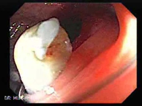 Colonoscopic Polypectomy (20 of 23)