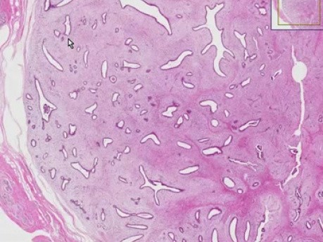 Fibroadenoma - Histopathology - Breast