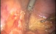 Robotic Colo-Anal Pullthrough Procedure - Difficult Male Pelvis