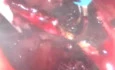 Transanal Surgery Using GelPoint Path. First Case in Brazil.
