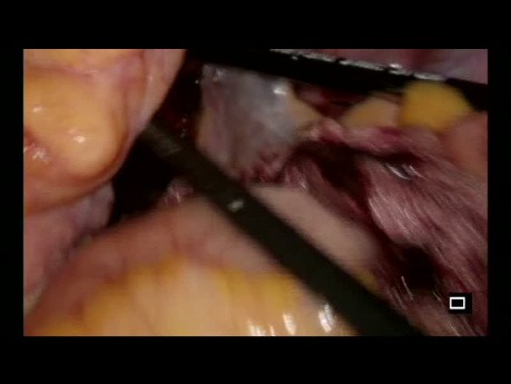 Laparoscopic Low Anterior Resection in an Elderly Patient for Middle Rectal Cancer Treated with Radiotherapy