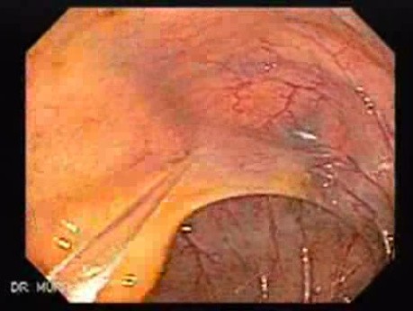 Multiple Rectal Ulcers (17 of 110)
