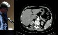 Spleen Haemangioma Treated by Partial Robotic Splenectomy
