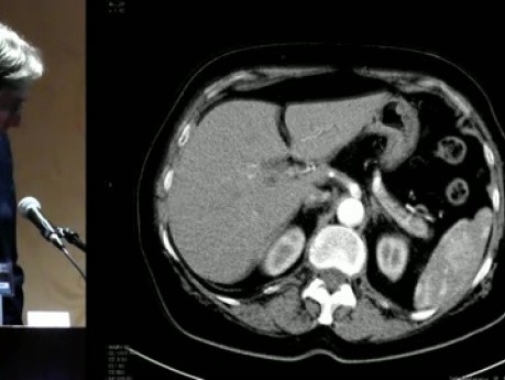 Spleen Haemangioma Treated by Partial Robotic Splenectomy