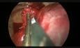 Uniportal Vats Resection of Complex Huge Bronchogenic Cyst