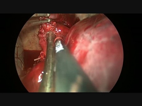 Uniportal Vats Resection of Complex Huge Bronchogenic Cyst