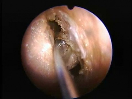 Anterior Ethmoidectomy - Endoscopy