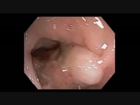 Colonoscopy Channel - Epinephrine Volume Reduction 2