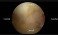 Biportal Endoscopic TransForaminal Interbody Fusion, Advance Biportal Endoscopic Spinal Surgery Technique