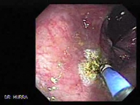 Rectal Dieulafoy’s Lesion (4 of 4)
