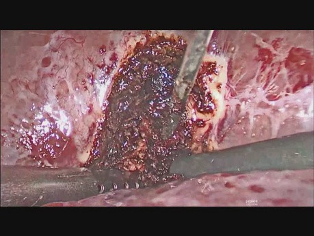 Laparoscopic Drainage of Liver Abscess
