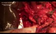 Whipple procedure (pancreatoduodenectomy)