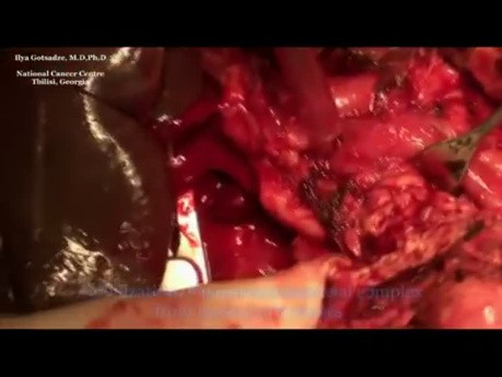 Whipple procedure (pancreatoduodenectomy)
