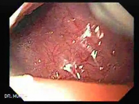 Squamous cell carcinoma of the tongue (3 of 3)