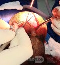 Meningocele in an 18-year-old patient