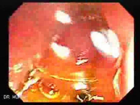 Invasive amebiasis and ameboma formation (1 of 4)
