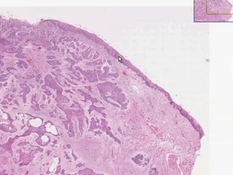 Squamous cell carcinoma